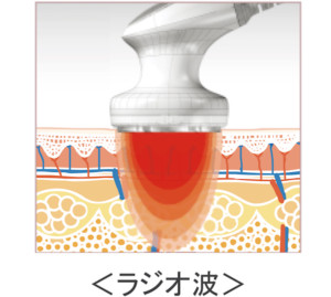 ラジオ波
