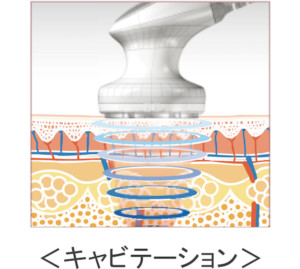 キャビテーション
